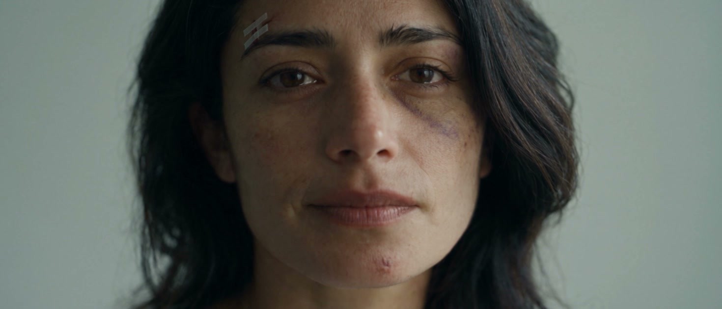 Valeria en la clínica, con un moretón que se desvanece y tiras adhesivas sobre la ceja, bajo una luz gris verdosa.